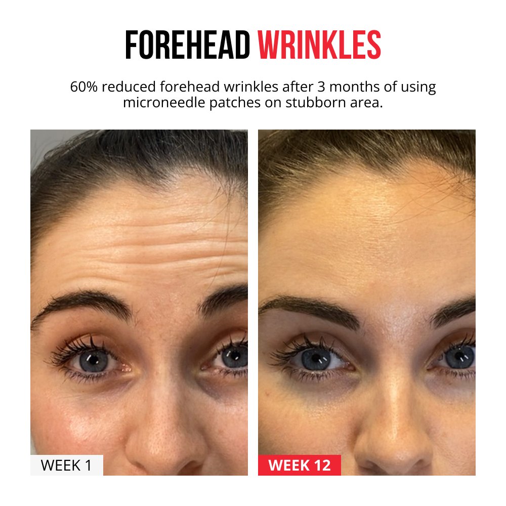 Parches de microagujas autodisolventes