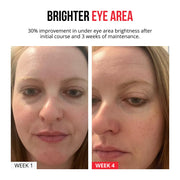 Parches de microagujas autodisolventes