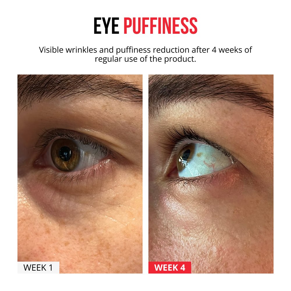 Parches de microagujas autodisolventes